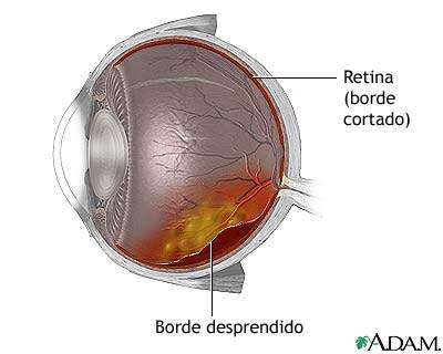 Devuelven visión a pesar de desprendimiento retina
