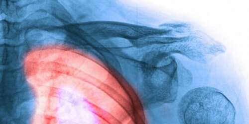 Aumenta la incidencia del cáncer de pulmón en las puertorriqueñas