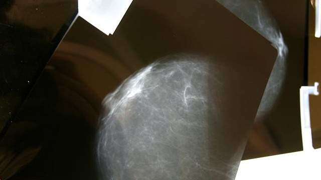 Conoce los beneficios de la inmonoterapia en pacientes con cáncer de seno