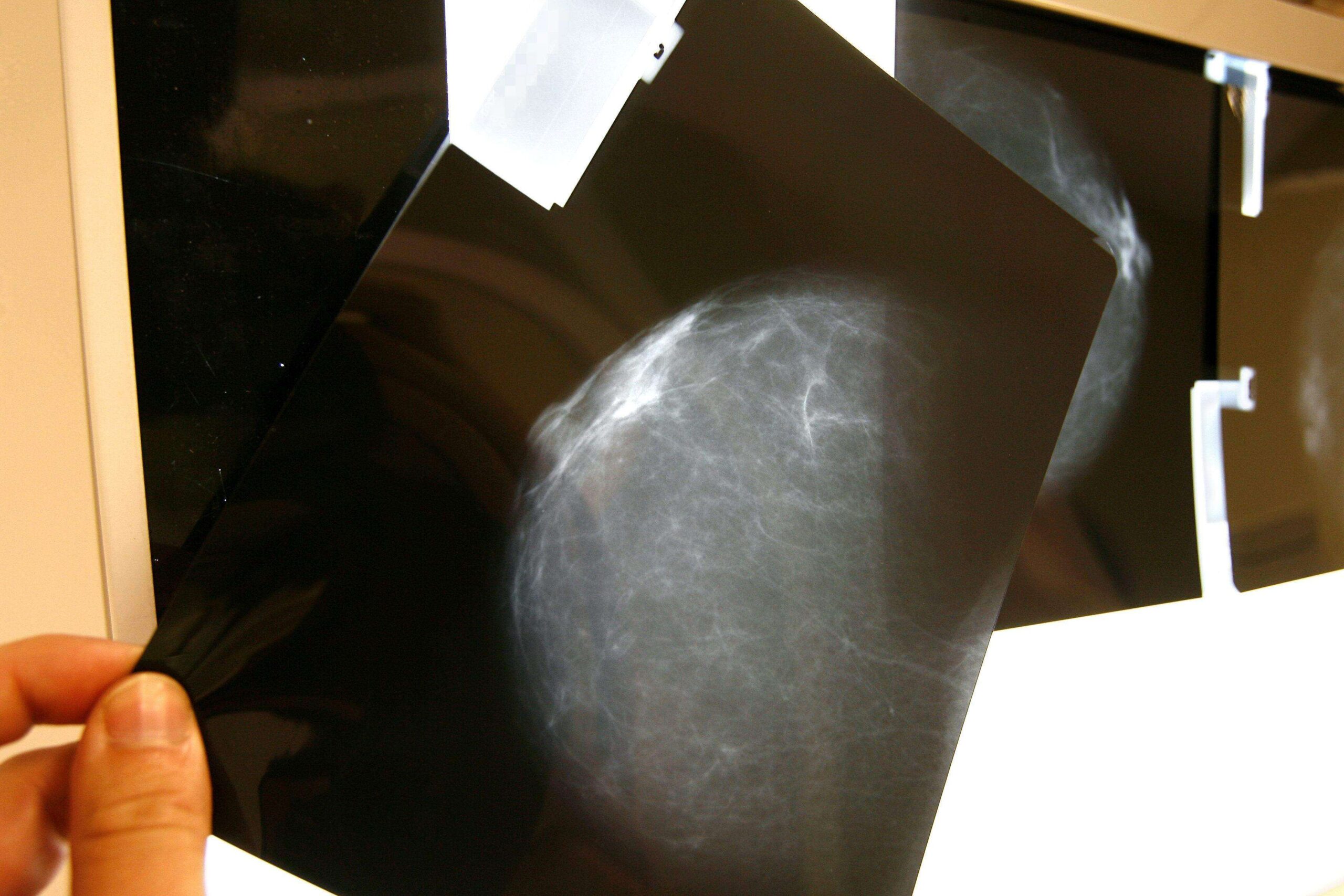 Las claves de la lucha contra el cáncer