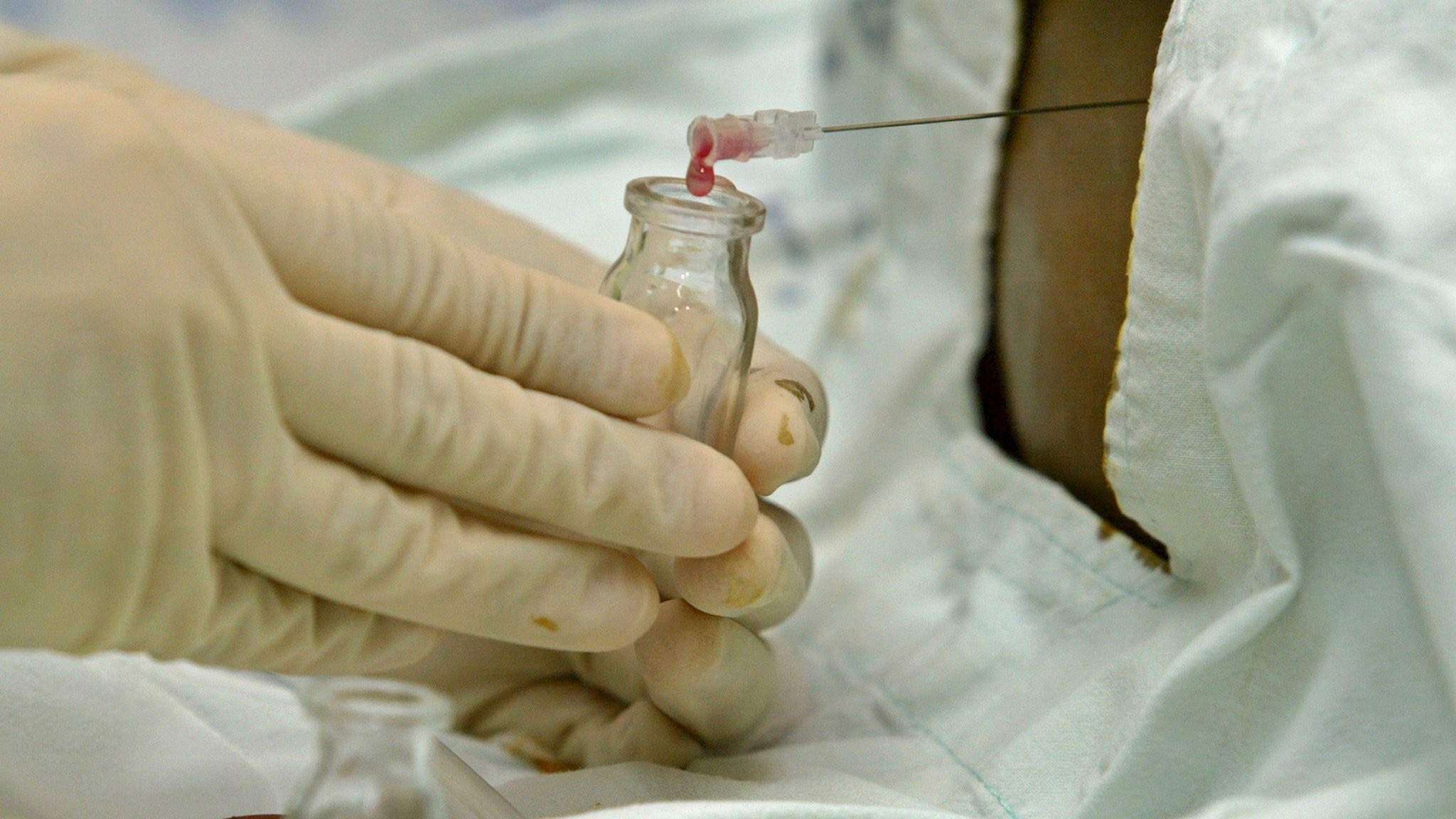 Conoce qué es el cáncer de mieloma múltiple