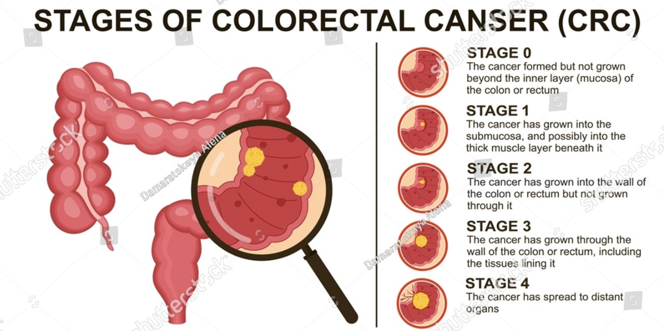 La incidencia del cáncer de recto aumenta tras décadas de descenso