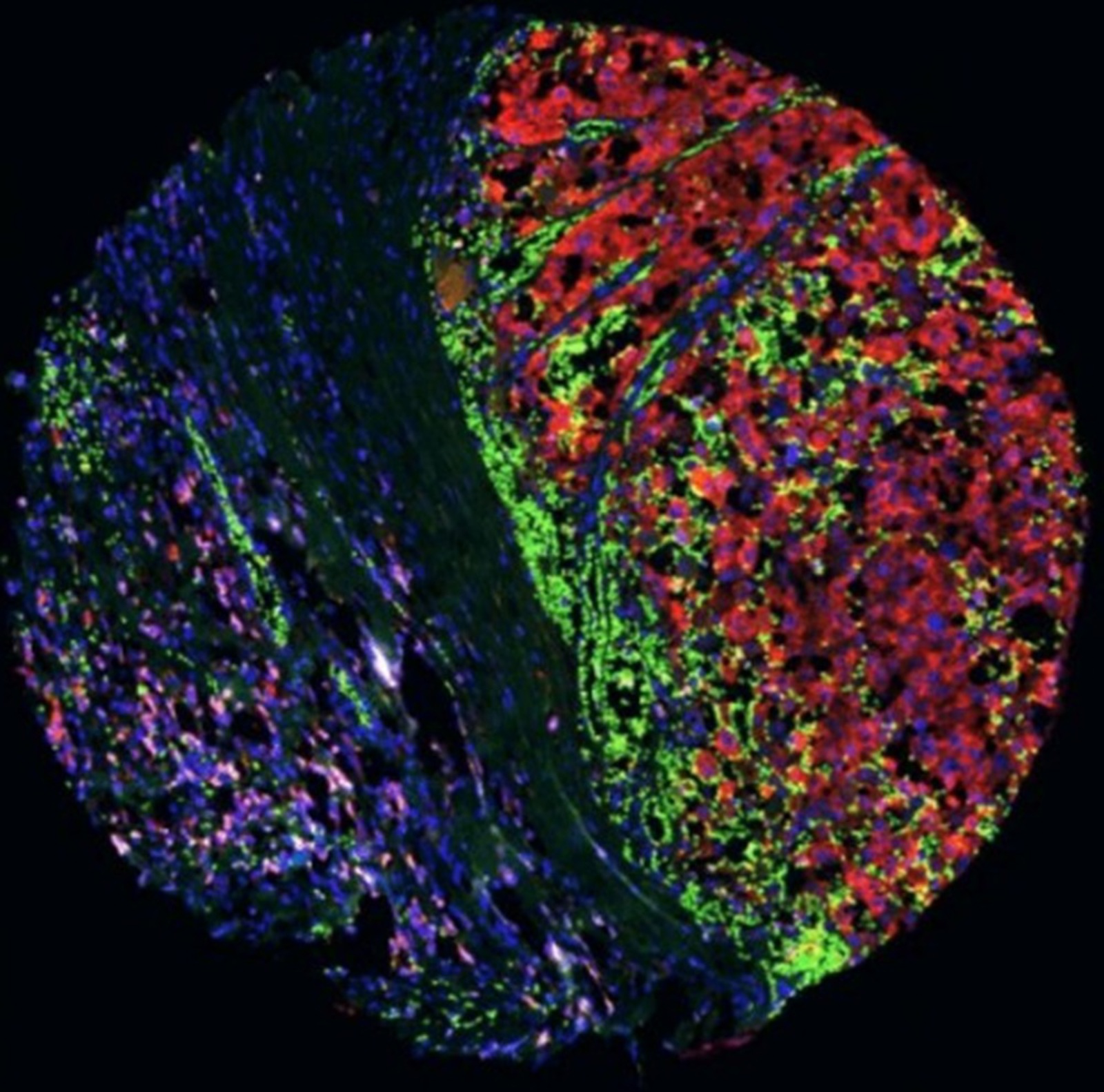Una estrategia experimental reduce la metástasis del melanoma y mejora la inmunoterapia
